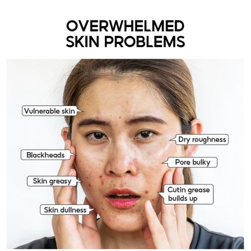 Lanbena Salicylic Acid Acne Treatment Soap Pore Exfoliating Softening Skin Face Deep Cleansing Foam