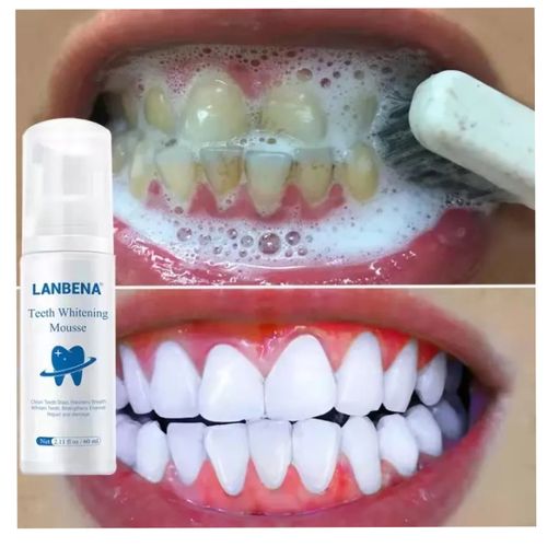 Lanbena Faster Teeth Whitener 60mls - 10pcs