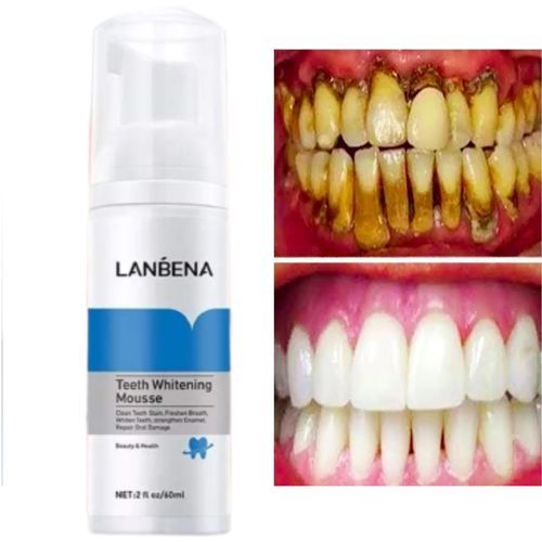 Lanbena Afforddable Teeth Whitening Mousse Tooth Cleaning Remove Quick Repair Of Cavities Caries Filling Removal Of Stains Plaque Decay Yellowing  White Teeth Oral Hygiene Toothpaste Bleaching Whitening Dental Tool Real Teeth Whitener - White 2fl Oz /60ml