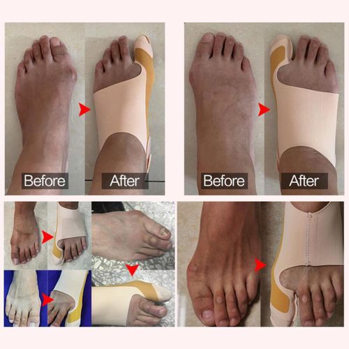 Thumb Bunion Orthopedic Corrector Hallux Valgus Pedicure Socks S Right