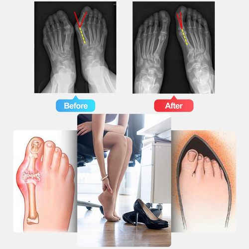 Thumb Bunion Orthopedic Corrector Hallux Valgus Pedicure Socks S Right