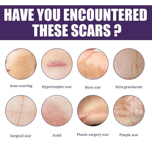 Silicone  Sheets For Scars Caused By , Keloid,