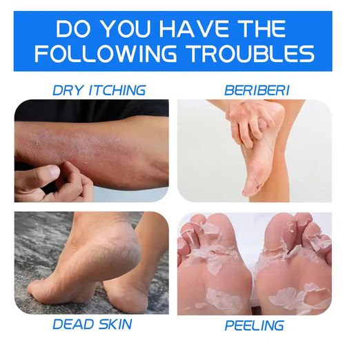 Dry Cracked heel balm Callus Remover foot cream repair Moisturizing