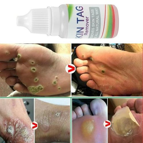 Sumifun Skin Tag Mole & Genital Wart, Foot Corn Removal 10ml