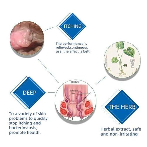 Healmusz Hemorrhoid Ointment Natural Herbal Fast Relief Hemorrhoid/piles Cream.