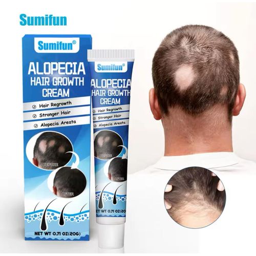 Lanbena Sumifun Alopecia Hair Growth Cream: Your Ultimate Solution to Hair Loss