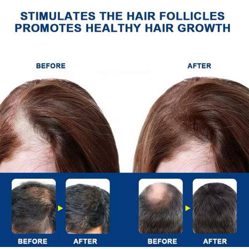 Lanbena Sumifun Alopecia Hair Growth Cream: Your Ultimate Solution to Hair Loss