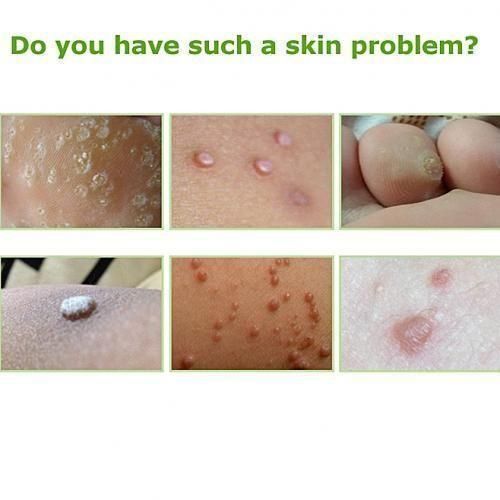 Skin Tag Mole & Genital Wart, Foot Corn Removal 10ml