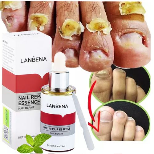 Lanbena Nail Repair Essence Serum Fungal Nail Treatment - 15mls