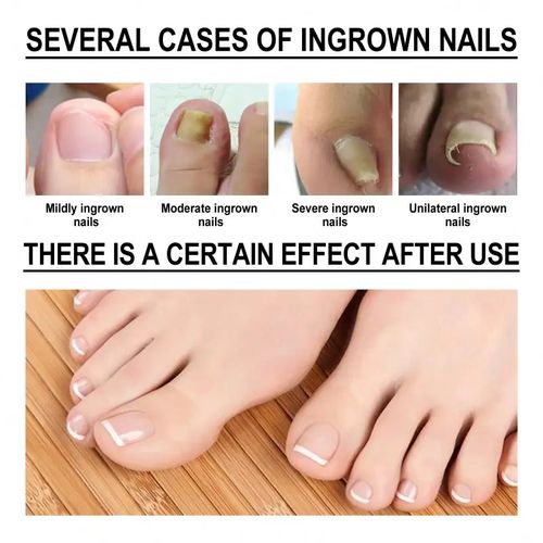 Lanbena Nail Repair Essence Serum Fungal Nail Treatment - 15mls