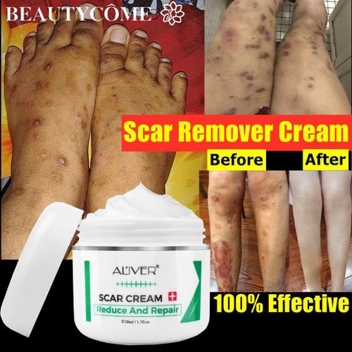 Lanbena Aliver Scar Removal Cream