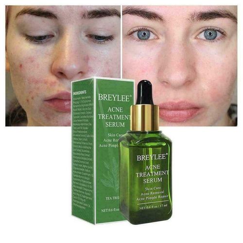 Breylee Acne Treatment Serum - 17mls