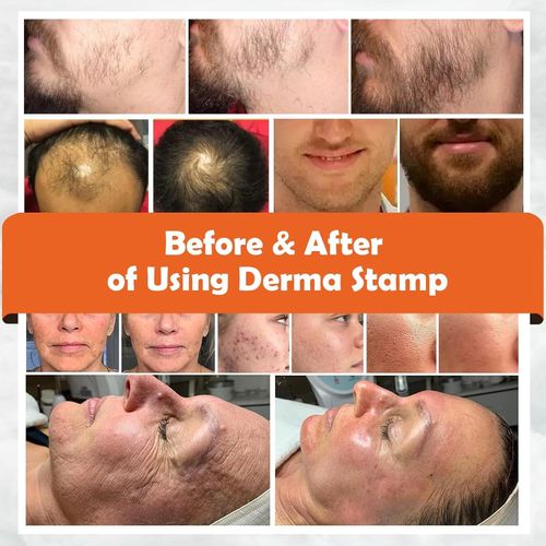 140 Titanium Derma Stamp