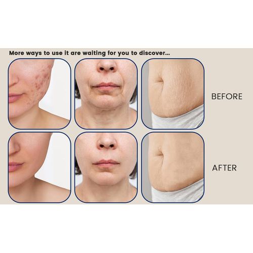 140 Titanium Derma Stamp