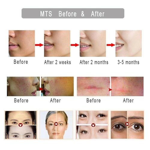 Derma Roller Stamp 140 Microneedle Skin Care Therapy Anti Aging Scar Wrinkle Stainless Steel Microneedle