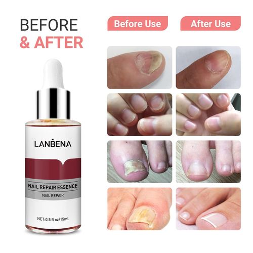 Lanbena Nail Treatment Nail Care Serum Protect Nail from Damage Fingernail and Toenail Repair for Curing Athlete's Foot and Prevent Nail from Infection Discoloured & Damaged Nails(15ml)