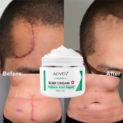 Aliver Scar Cream, Stretch Marks Remover, Ideal for Acne, C-Section, Burns, Surgical Scars Treatment, Effective for Old and New Scars