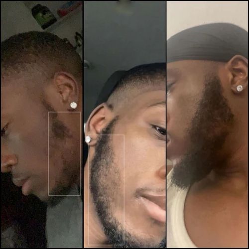 Kirkland Minoxidil 1 Month Kirkland 5% Solution & Derma Roller
