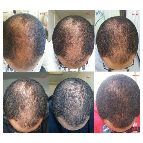 Kirkland Minoxidil 1 Month Kirkland 5% Solution & Derma Roller