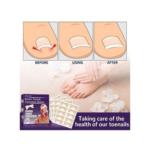 Toenail Corrector Patch  Free Ingrown Toenail Sticker For Toe Nail