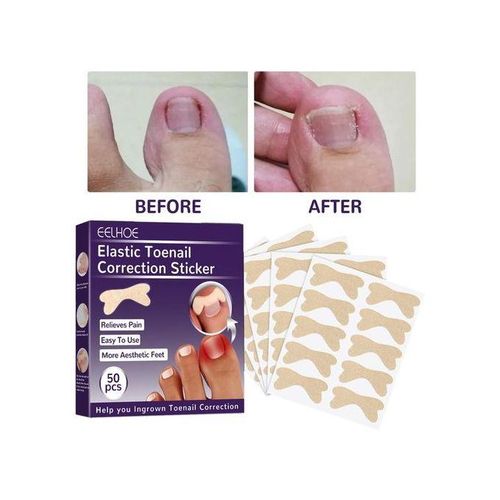 Toenail Corrector Patch  Free Ingrown Toenail Sticker For Toe Nail