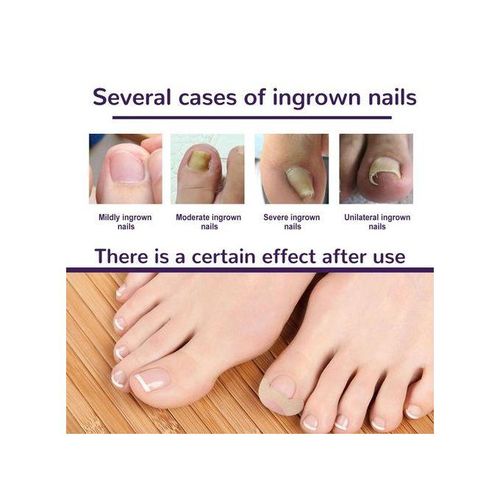 Toenail Corrector Patch  Free Ingrown Toenail Sticker For Toe Nail