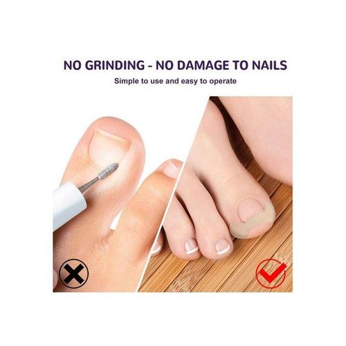 Toenail Corrector Patch  Free Ingrown Toenail Sticker For Toe Nail
