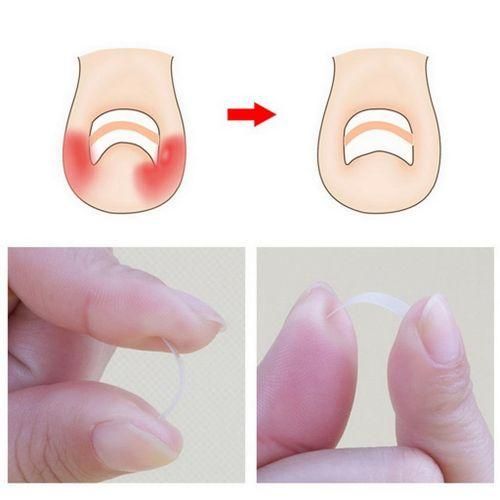 4x 10x Ingrown Toenail  Manicure Pedicure Brace Tool Toe