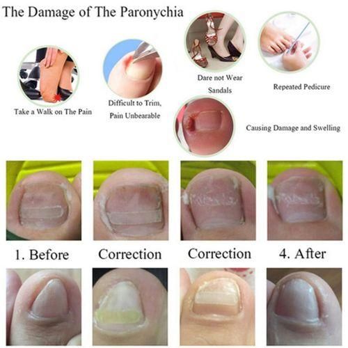4x 10x Ingrown Toenail  Manicure Pedicure Brace Tool Toe
