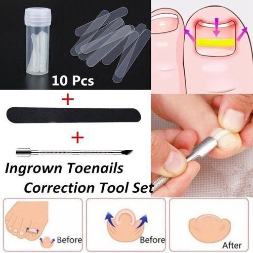 Professional Ingrown Toenail  Clip  Treatment