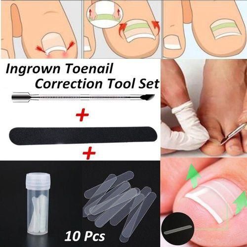 Professional Ingrown Toenail  Clip  Treatment