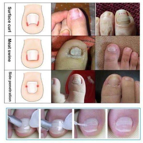 Professional Ingrown Toenail  Clip  Treatment