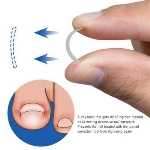 Professional Ingrown Toenail  Clip  Treatment