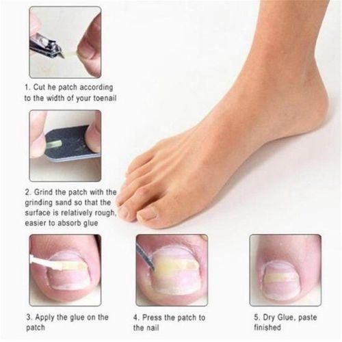 Professional Ingrown Toenail  Clip  Treatment