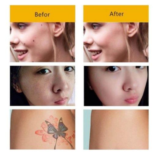 LCD Screen Laser Freckle Warts Dot Mole Dark Spot Tattoo Removal Pen Skin Beauty