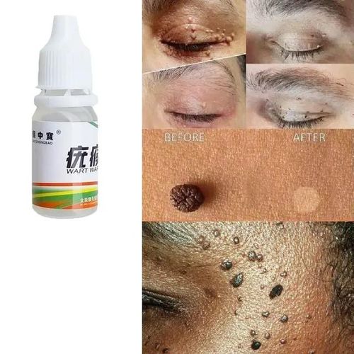 Sumifun Skin Tag Mole & Genital Wart, Foot Corn Removal 10ml