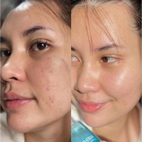 Cerave Acne Control Cleanser With 2% Salicylic Acid 237ml